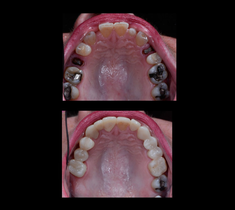 Brandy's teeth before and after