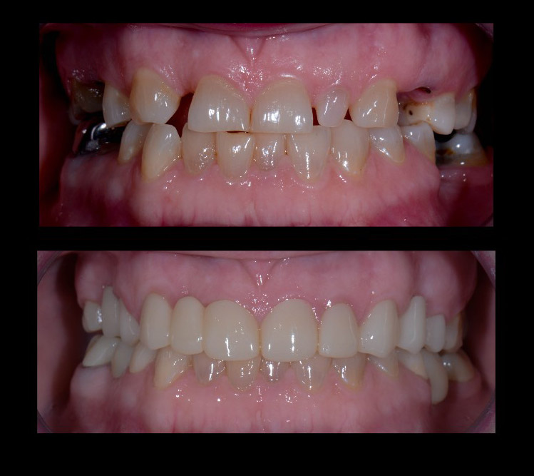 Brandy's teeth before and after