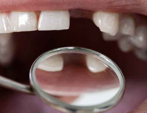 Missing a Tooth? Here Are Your Best Options for a Confident Smile