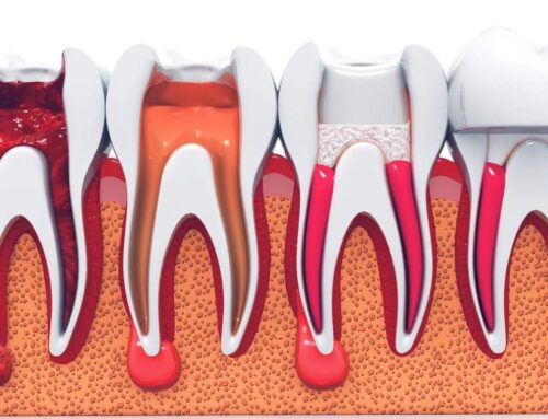 5 Signs You May Need a Root Canal