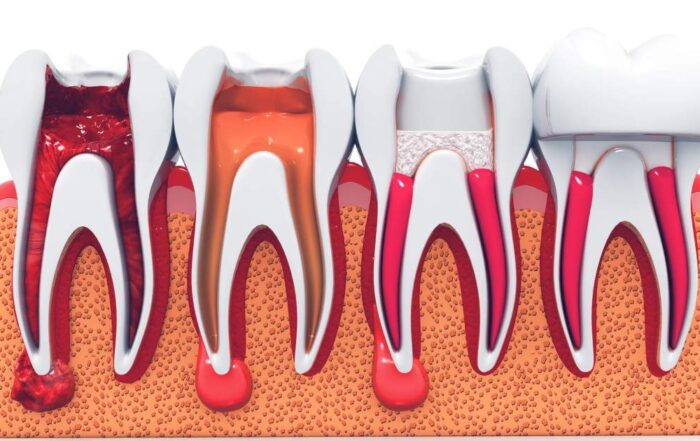 4 stages of a root canal