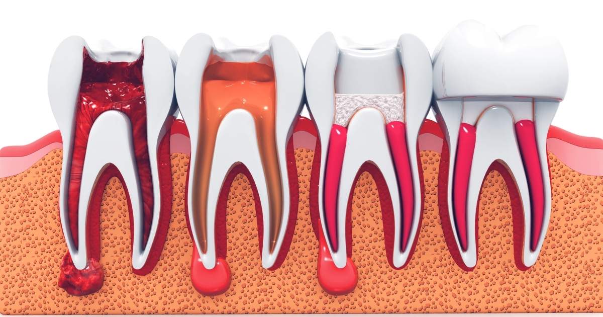 4 stages of a root canal